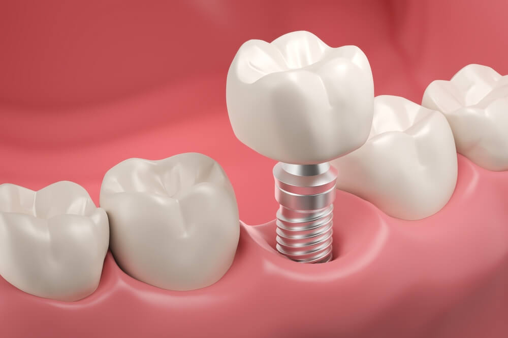 implant zębowy